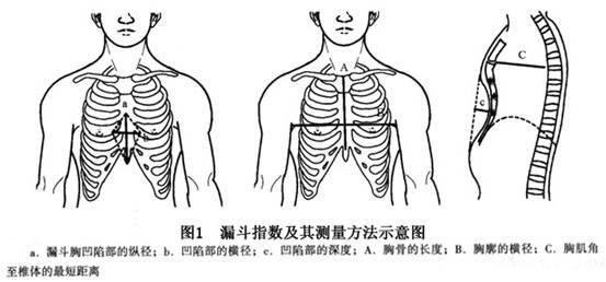 宝宝胸前有个坑咋回事鸡胸姊妹篇