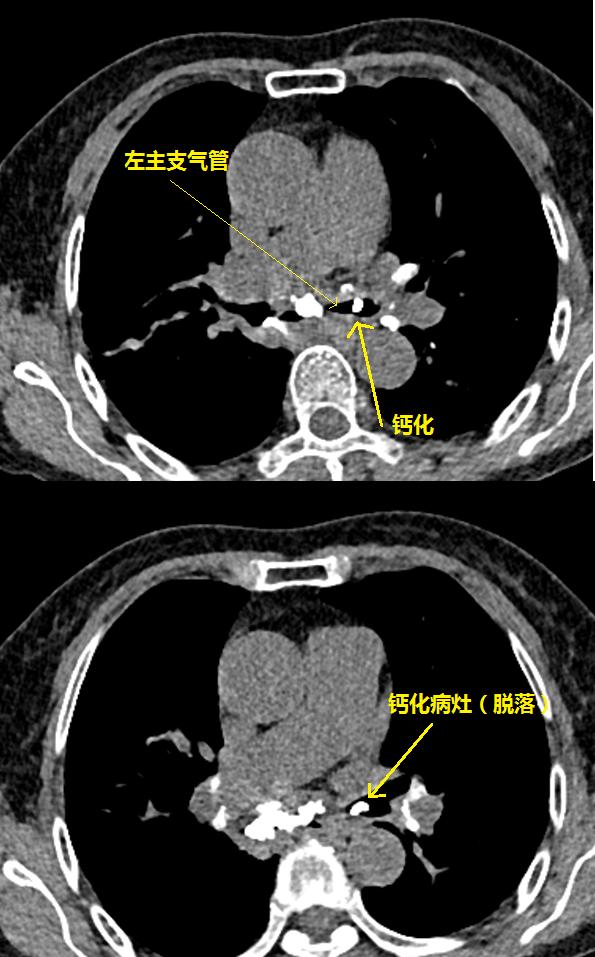 肺部钙化灶脱落,掉进左主支气管(图8,因为钙化病灶是坚硬的,锐利的