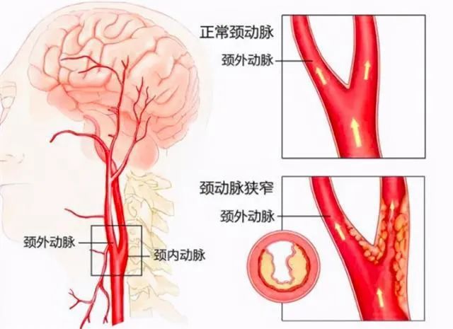 引起颈动脉狭窄的主要原因是动脉粥样硬化,约占90%以上,其余原因包括