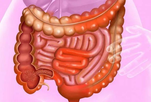 肠梗阻是什么病?它是由什么引起的?
