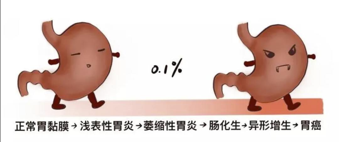 一般来说,大多数胃癌的发展遵循如下规律:正常胃粘膜-非萎缩性胃炎