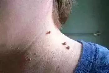不痛不痒就没事?身上的肉疙瘩,有3种会传染,1种能遗传