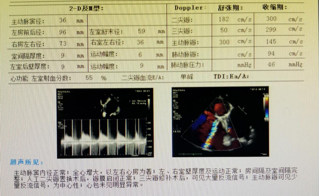 这例巨大心房易误诊,临床切勿