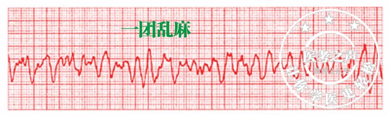 ②心室纤颤(vf):心室呈不规则蠕动.