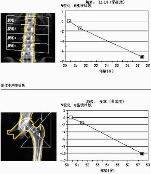 我连续吃了七年的钙片,为何骨密度还在直线下降?