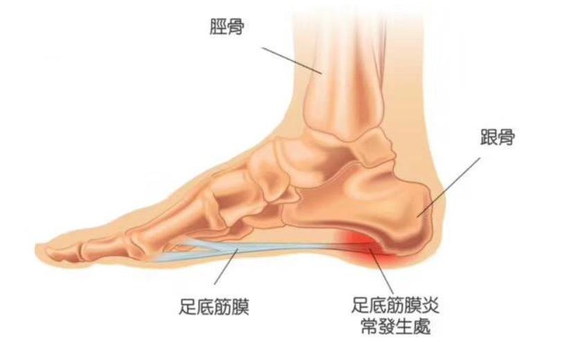 例如下图中的红色区域就是足底筋膜损伤最常出现的位置.