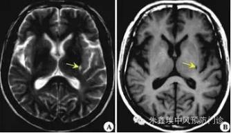 脑内腔隙灶脑梗死病灶