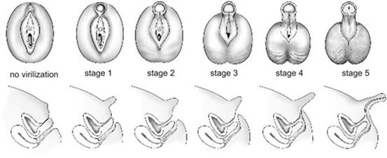 有正常卵巢和内生殖器,外生殖器为两性畸形.