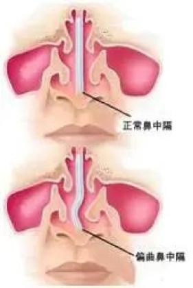 鼻塞喷嚏不断就是鼻炎no有可能是鼻中隔偏曲惹的祸
