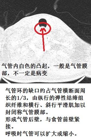 气管里一大个肿物,普通ct平扫为什么漏诊?