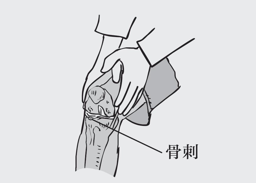 如何才能把骨刺消掉?