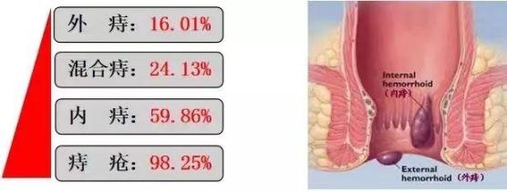 痔是指直肠末端黏膜下及肛门黏膜的静脉丛发生曲张而形成的柔软静脉团