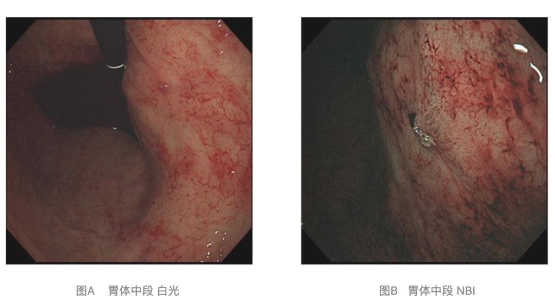 腹痛2周伴黑便,遇到杜氏病,内镜下如何快速止血?