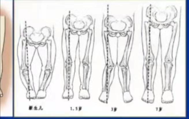 宝宝1岁感觉有点"o型腿",用不用矫正?