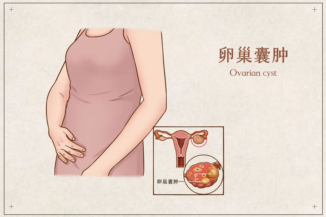 年纪轻轻查出卵巢囊肿,会导致不孕和癌变吗?
