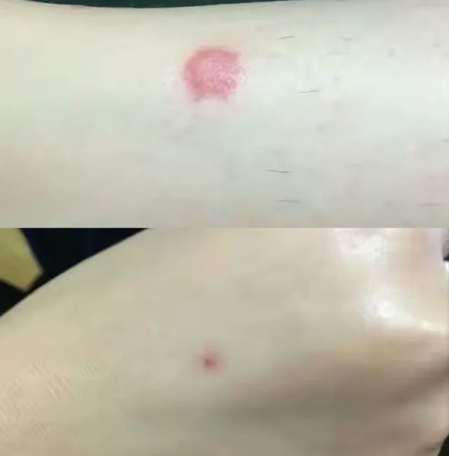 同样被蚊子咬,大肿包代表身体虚,小红点说明身体好?