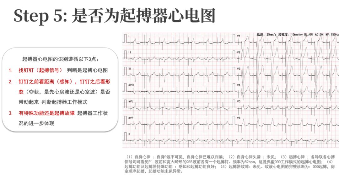 心电图的五步法判读