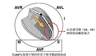 抢救急性心肌梗死必备罪犯血管这样定位
