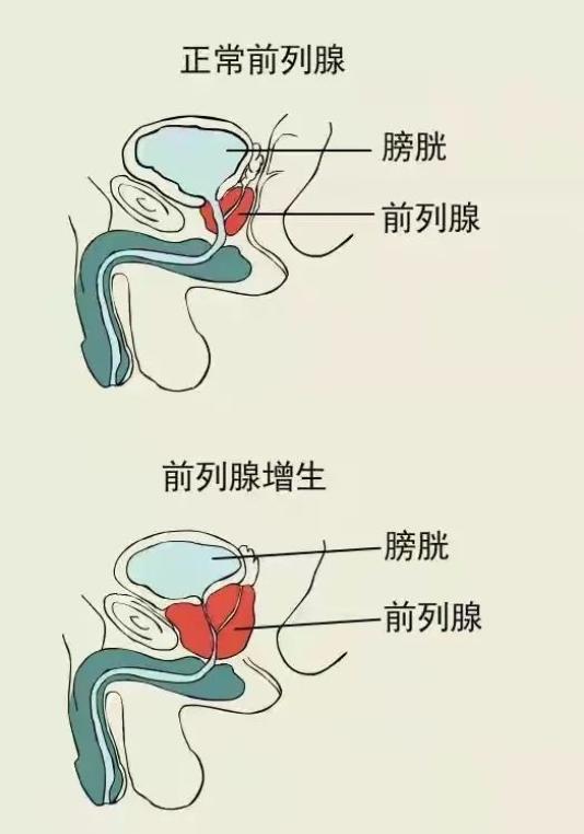 男性前列腺也一样,年龄长,它也长,前列腺增生是一种正常的生理现象.
