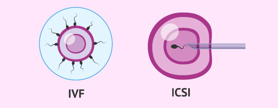 "二代"试管婴儿技术即卵胞浆内单精子注射(icsi,是将经过挑选的精子