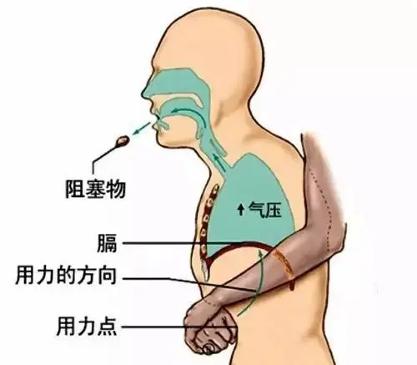 气管异物其实离我们很近