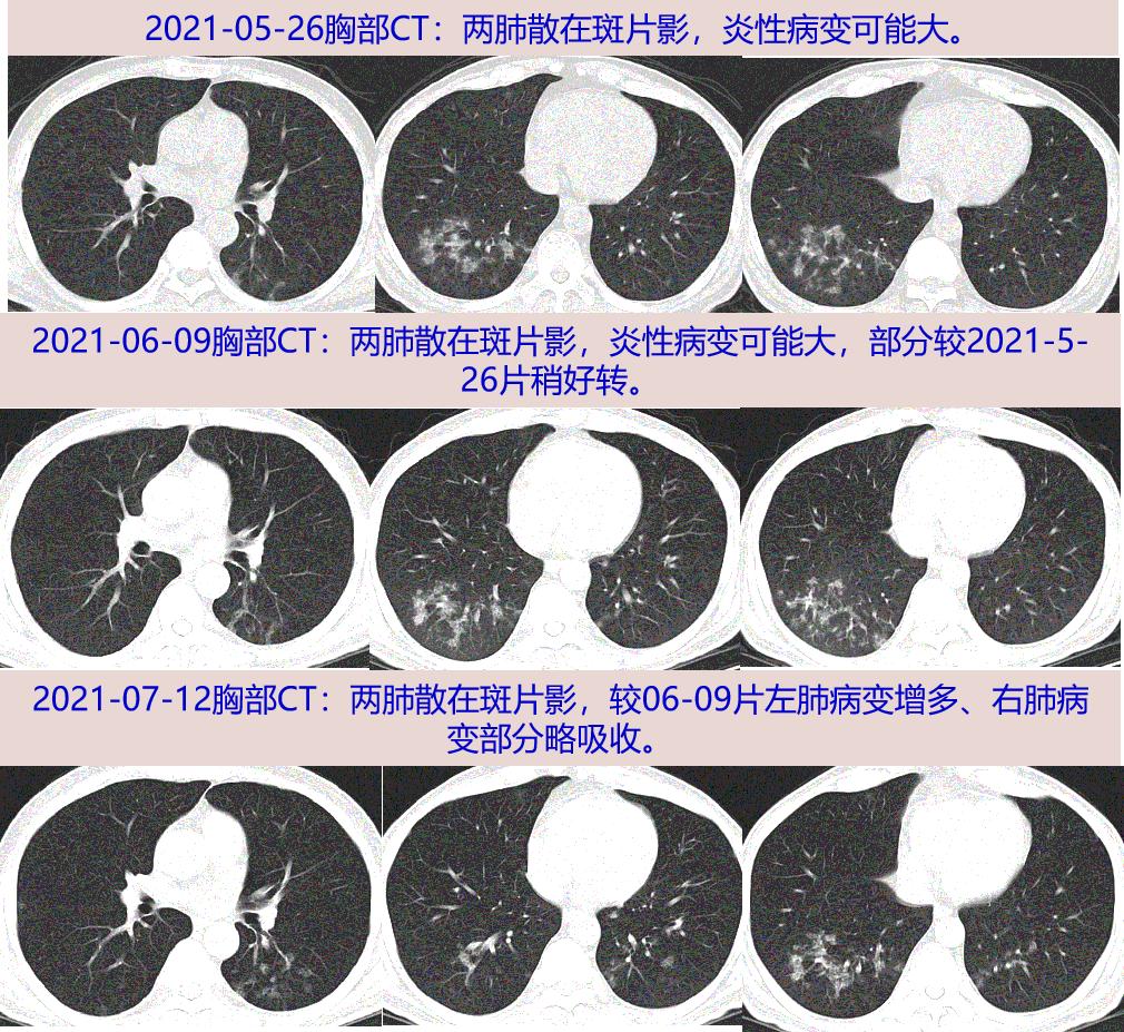 探案丨双肺阴影竟为ta小小细节解迷团