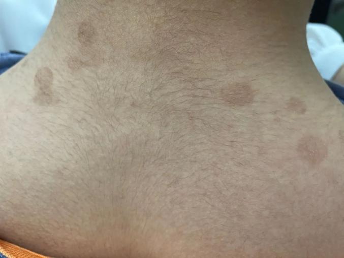 夏日炎炎 "汗斑"莫猖獗健康科普,便民发布上海儿童医学中心皮肤科