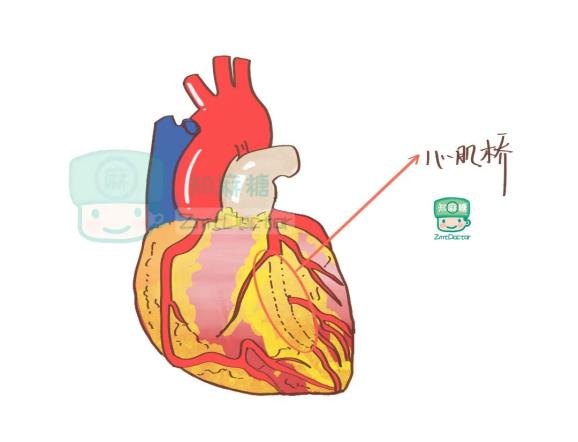 心肌桥一这位熟悉又陌生的朋友今天我们就来聊一聊医学界也开始重新