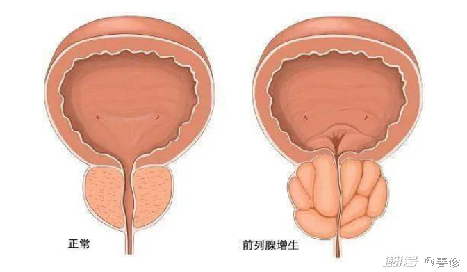 前列腺炎偏爱中青年男性