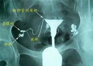 输卵管粘连还能自然怀孕吗