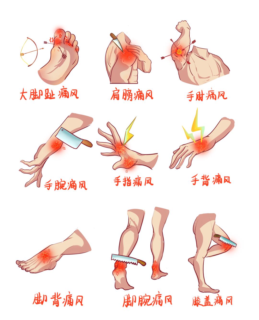 肿胀,痛风发作时,关节红,肿,热,痛一起来,以大脚趾(第一跖趾关节),踝