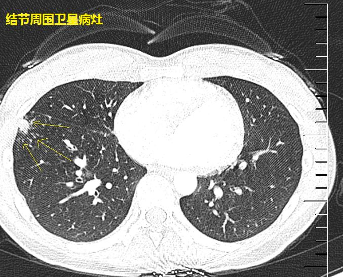 医学界呼吸频道图6-12 结节 卫星病灶 纵隔淋巴结多发肿大 年轻人