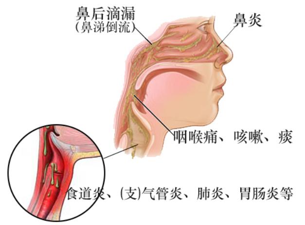 鼻后滴漏综合征,是指因各种病因导致的鼻腔或鼻窦炎性分泌物经后鼻孔