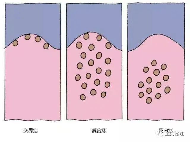 身上的痣有这4种情况一定要注意