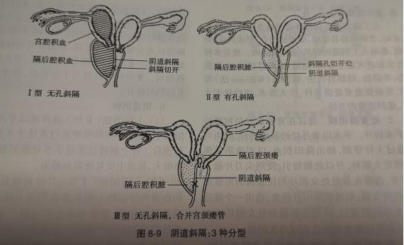 12岁女孩痛经难忍,原来是长了双子宫