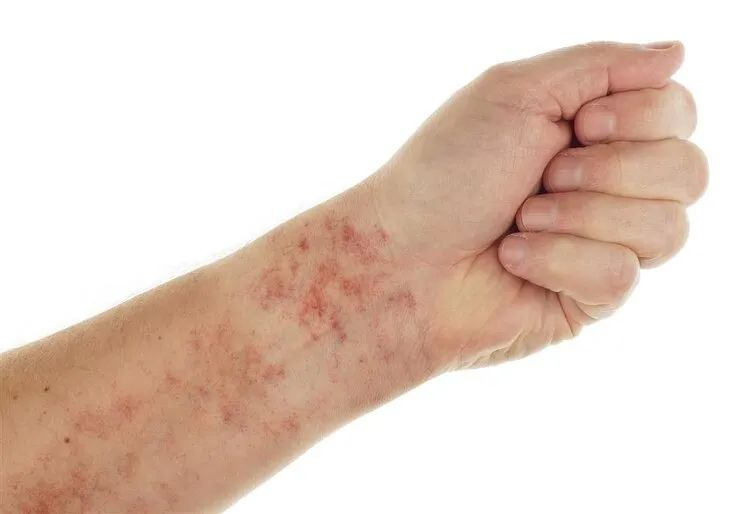 湿疹,皮炎,痱子&……夏季皮肤病高发怎么办?