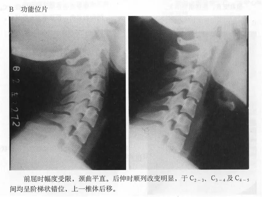 张口位片:了解第1,2颈椎之间的关系是否正常.
