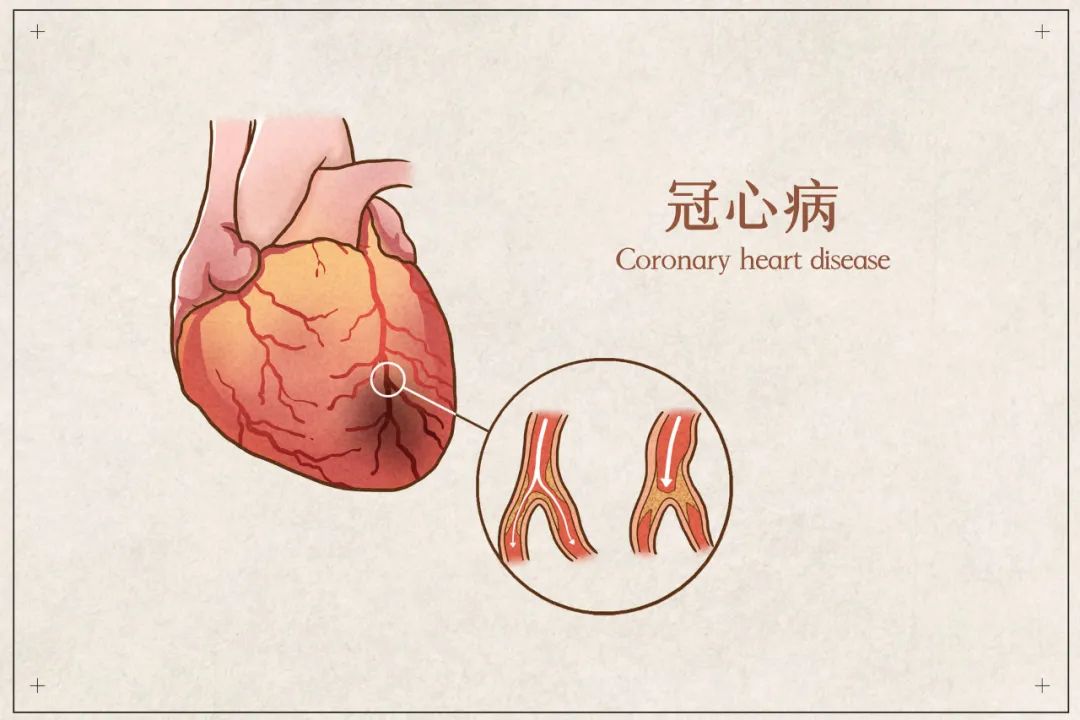 死亡率居高不下的冠心病你了解多少