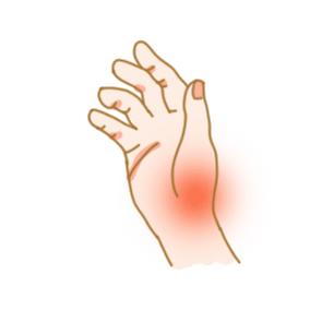 jingyitong 腱鞘炎除了会有「局部疼痛」,「压痛」,还有其他三种症状