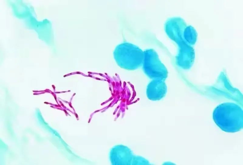 女病人被误认为结核差点被逼疯,其实是结核菌的"小兄弟"感染