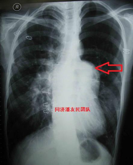 室间隔缺损合并重度肺动脉高压的胸片(红箭头显示肺动脉段突出)