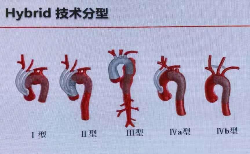 第一医疗 | 市一心脏及大血管外科应用hybrid技术救治一急性a型主动脉