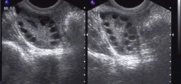 下面这个图是多囊卵巢最典型的超声图像,卵泡串珠样改变.