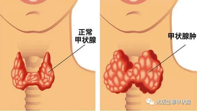 甲状腺肿大的常见原因