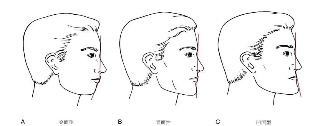 侧脸不好看怎么改善?