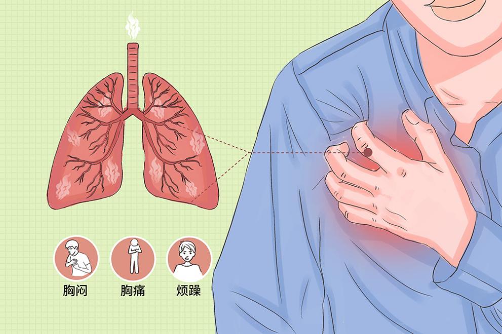 科普| 气胸患者胸腔注入粘连剂的七个q&a