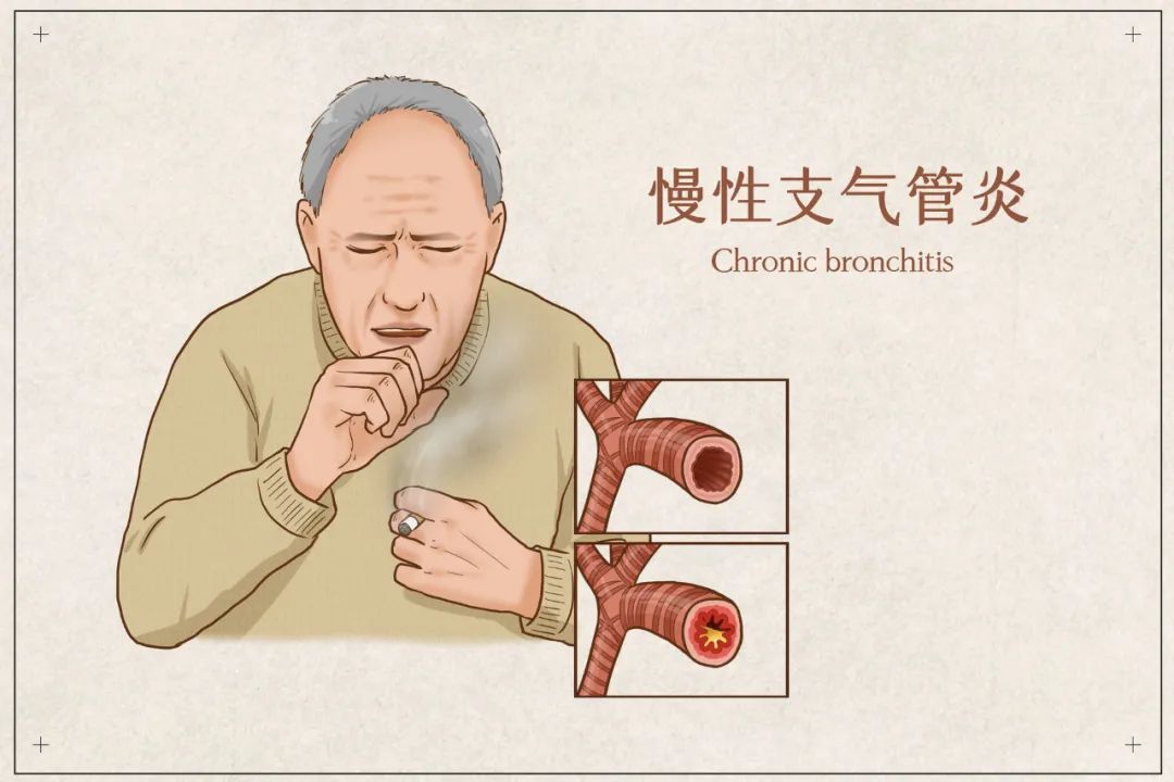 慢性支气管炎危害大如何正确预防呢