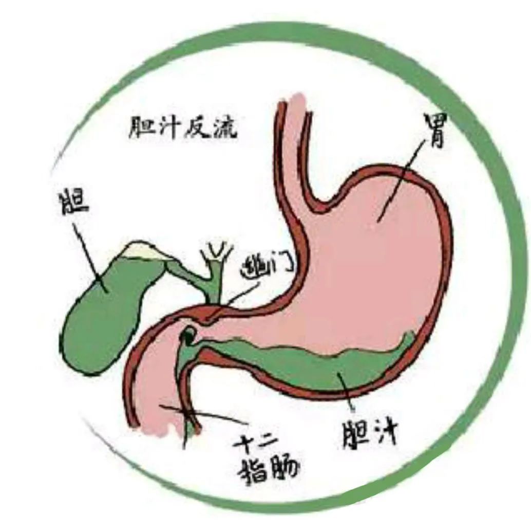 胃一直胀气胃镜检查结果是胆汁返流该怎么办
