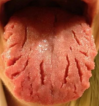 是萎缩性舌炎的表现,高发于中老年妇女,可能与全身性疾病或者真菌感染