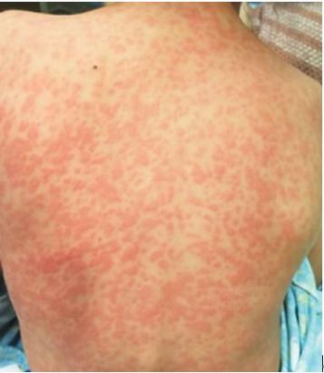 上有"脓性分泌物""在基层医院静滴阿莫西林,不久身上出现了红色皮疹